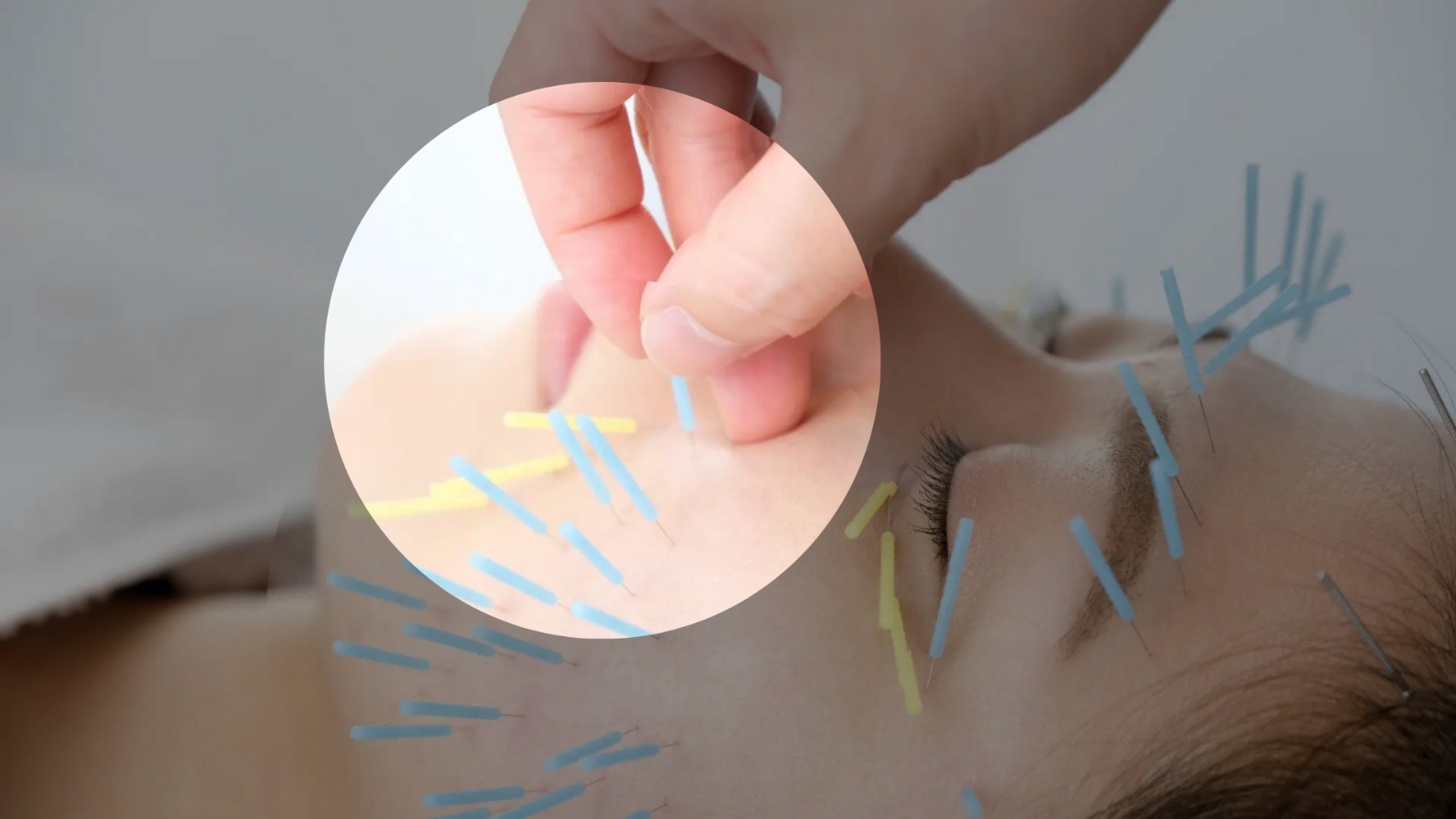 Cosmetic facial acupuncture treatment